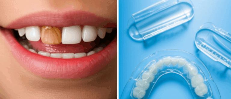 Are Dentist Whitening Trays Worth It