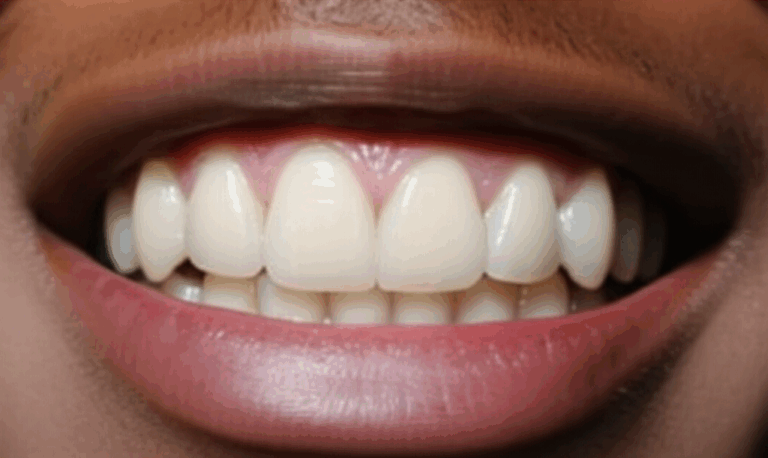 Did Lil Durk Get Veneers Unpacking His Smile Transformation And Dental Work